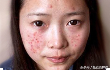 如何去除痘印和黑头,如何祛除痘印学生党