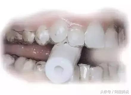 隐适美矫正摘戴攻略,隐适美和正雅隐形矫正哪个好