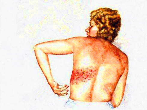 牙疼放了杀神经药还疼怎么缓解,牙痛神经痛可以根管治疗吗