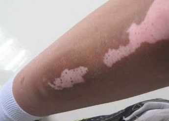 白癜风治疗要多久?还有哪些要注意?