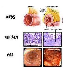 克罗恩病简介,克罗恩病的病因
