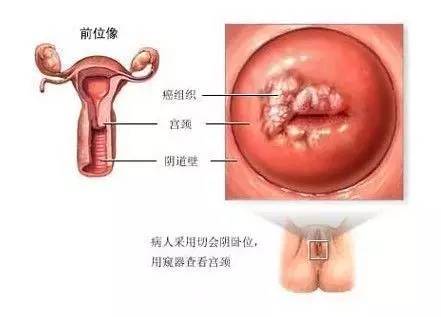 宫颈癌筛查三阶梯,宫颈癌筛查科普最新版