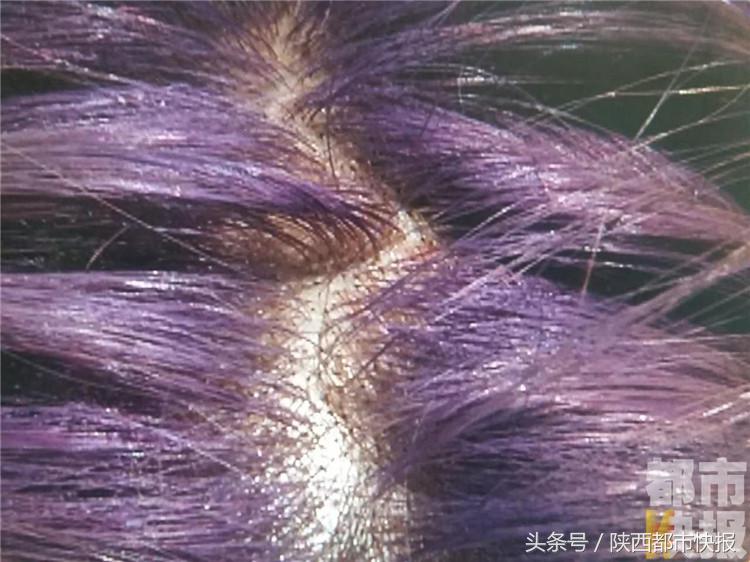 西安女生染头发发根受损,女孩爱美染发导致濒死