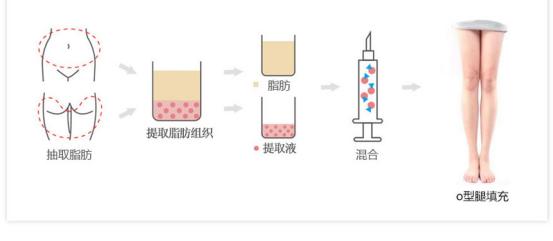 王明利自体脂肪丰臀怎么样,穿什么可以显腿瘦