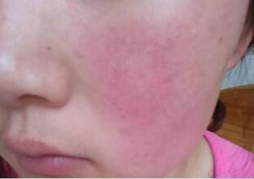 面部红血丝最快的解决方法,脸上的红血丝彻底根除的方法