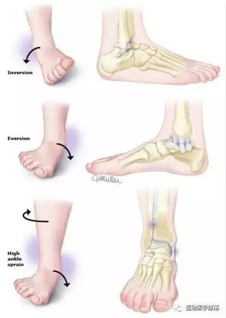 崴脚了四个多月反复不好,崴脚反复扭伤中医怎么治
