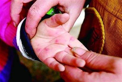 2岁宝宝嘴巴周边长了一圈红点点,小孩嘴巴里面长红点点是怎么回事