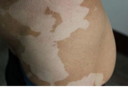 白癜风进入稳定期后如何治疗,稳定期的白癜风需要治疗吗