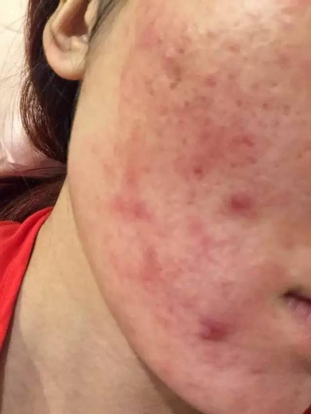 服用激素脸会发红发烫吗,激素脸发红发烫时该怎么办