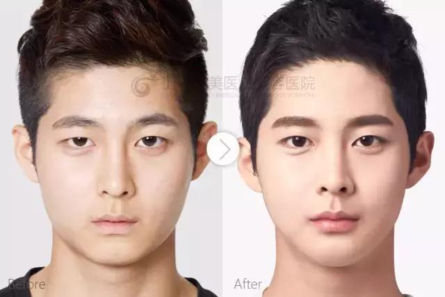 越来越多的男性整形,男士整容变帅案例