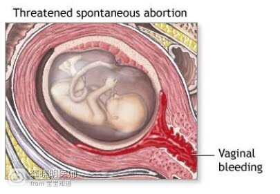 早孕生化出血怎么办,医学博士科普怀孕