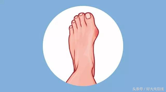 脚上磨出泡用红霉素软膏管用吗,脚上磨出泡怎么处理