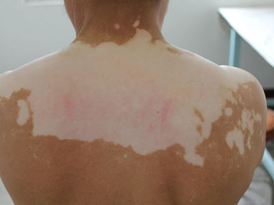 白癜风进入稳定期后如何治疗,稳定期的白癜风需要治疗吗