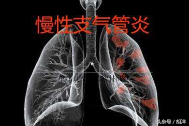 为什么有的人抽烟不会有肺气肿呢,有的人抽烟喝酒为什么长寿