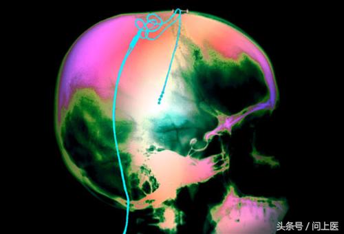 全方面了解帕金森疾病,从小帕金森怎样锻炼