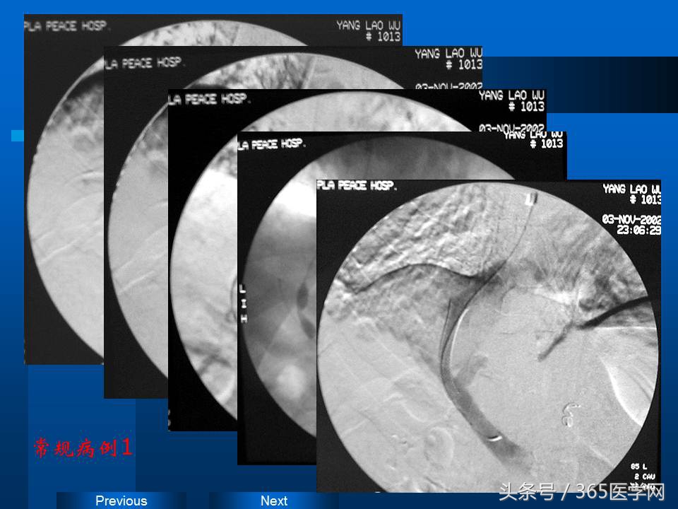 崔进国：消化道出血的介入治疗