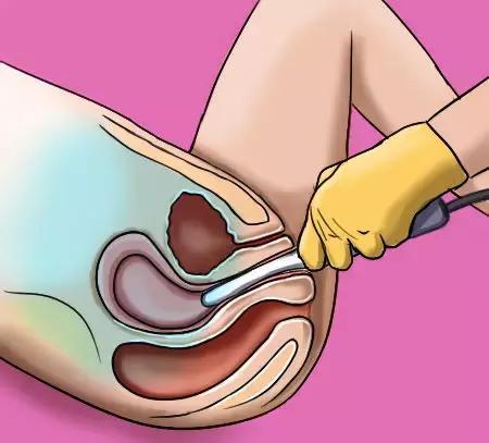 入职体检妇科项目有哪些,老年妇女妇科检查体检项目