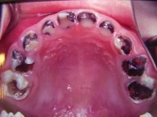 牙越来越黑是什么原因,牙为什么会黄或黑