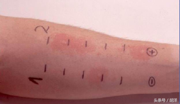 支气管哮喘怎么治疗彻底除根,支气管哮喘有没有治好的案例