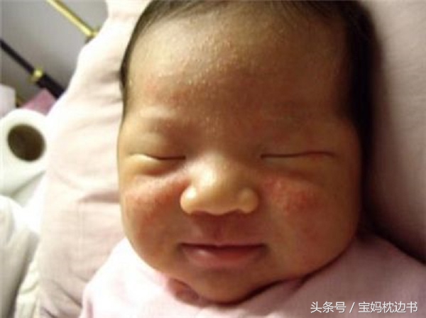 怎么判断是湿疹还是粟粒疹,宝宝湿疹丘疹