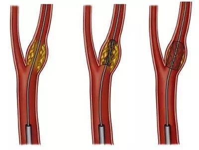 颈动脉缺血引起脑供血不足怎么办,颈动脉斑块会引起脑中风吗