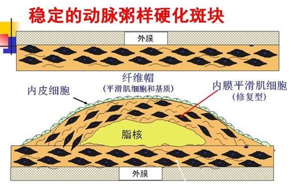 左侧股总动脉粥样斑块形成,吸烟造成动脉粥样斑块形成