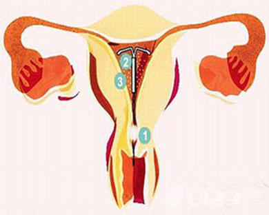 上环的避孕原理就是相当于刮宫吗,上环是刮宫还是不刮环