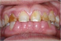 牙龈不增生的降压药,降压药引起的牙龈增生会好吗