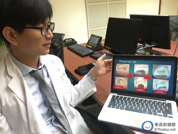 她脚趾甲卷成「吸管」状竟不是灰指甲在搞怪