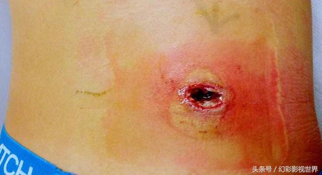 如果被毒蜘蛛咬伤了怎么处理,被毒蜘蛛咬伤应怎样处理