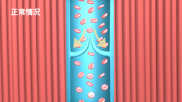 静脉曲张的病因及微创治疗方法？视频告诉你