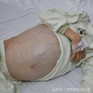 28岁小伙因为肝癌腹大如鼓，主任说太难治了！竟是这3点造成！