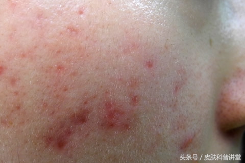 痘印痘痕怎么治,痘印和痘疤怎么治疗最好