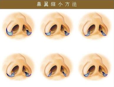 鼻翼缩小鼻子更大,让鼻翼缩小的方法