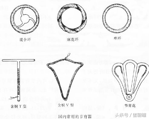 上环（宫内节育器）会导致感染和流产吗？