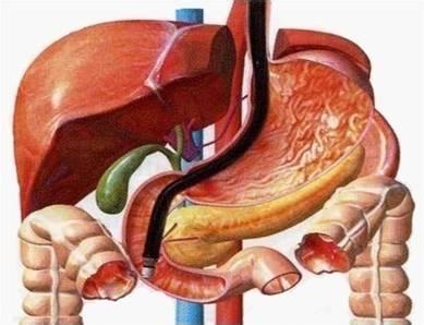 复发率高的最佳手术,复发后最佳挽救手术