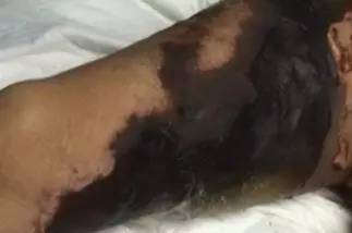 感冒脓毒血症,小孩感冒引起的脓毒血症