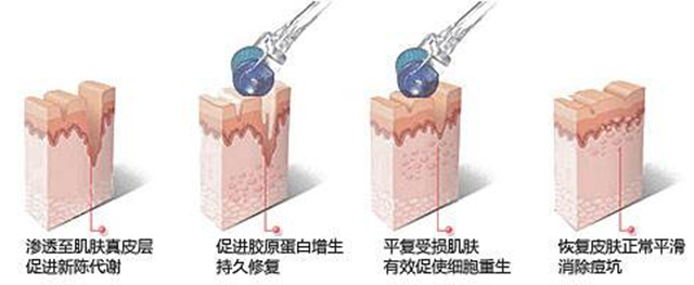 褐斑怎么治疗有效,褐斑怎么治疗效果最好