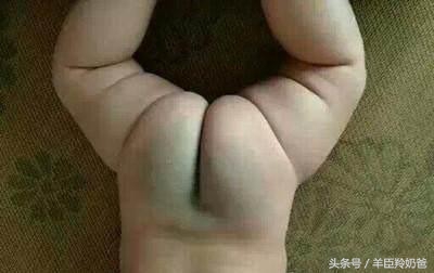 宝宝一出生脸上有一块褐色的胎记,宝宝一出生全身黑胎记