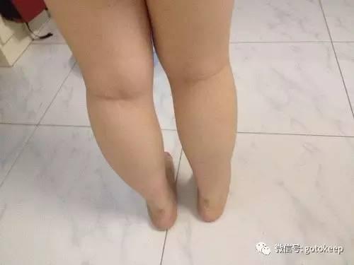 膝盖超伸腿粗矫正方法,膝超伸大腿粗怎么改善