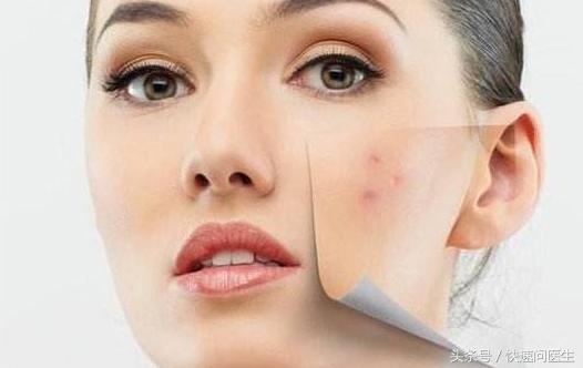 痘坑怎么修复点阵激光成都,为什么激光可以修复痘坑