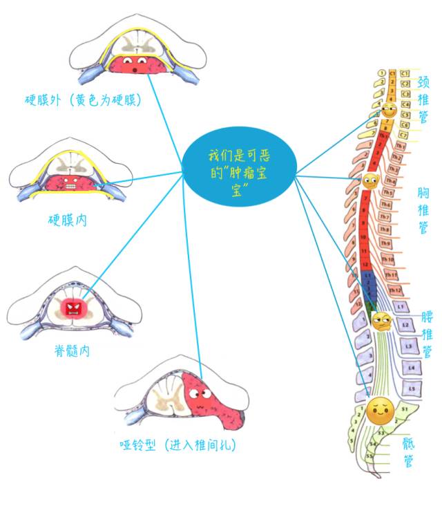 腰腿疼是椎管肿瘤吗,腰腿疼痛需要注意脊髓肿瘤吗