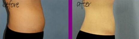 什么是腰腹抽脂,什么叫抽脂腰腹