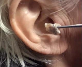 怎样才能挖到这么大块耳屎?恶心!但看着好爽啊!