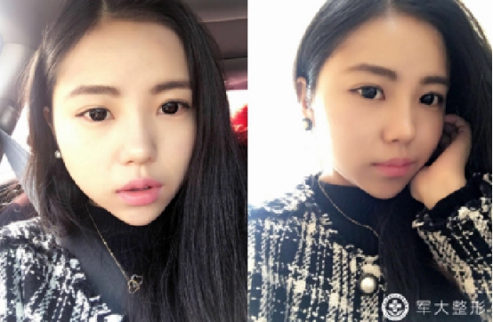 警惕微整形陷阱,整形美容的风险防范措施