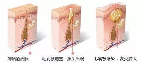 有痘痘怎么处理不留疤,有痘痘如何挤掉