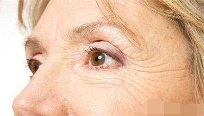 老年斑能去除吗怎么去除,咪喹莫特能祛除老年斑吗