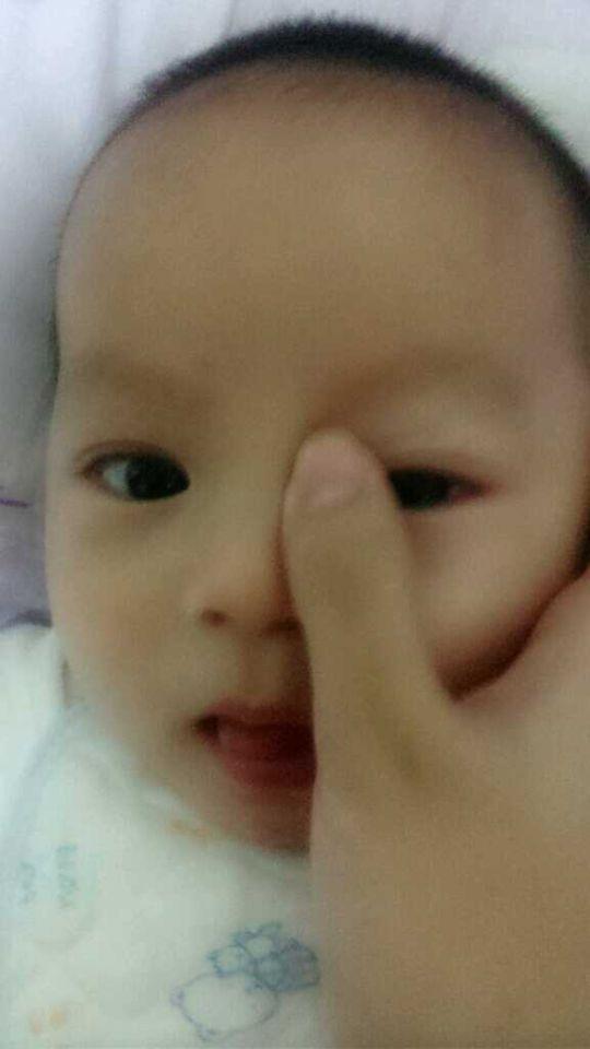 7个月婴儿泪腺不通要动手术吗,新生儿泪腺管不通怎么办