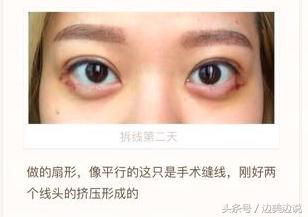 外科医生申霄,申霄医生双眼皮风格