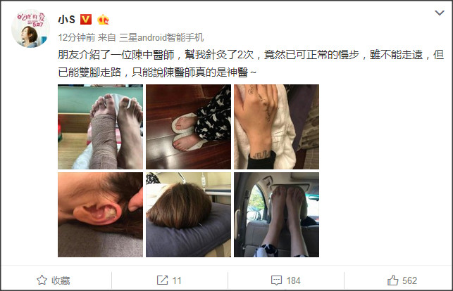 小S经过针灸2次已可慢步走路大赞中医博大精深